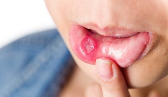 ağız içinde yara